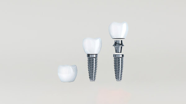 Dental Implants