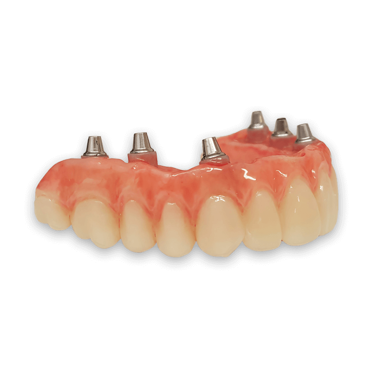 Implant Supported Dentures