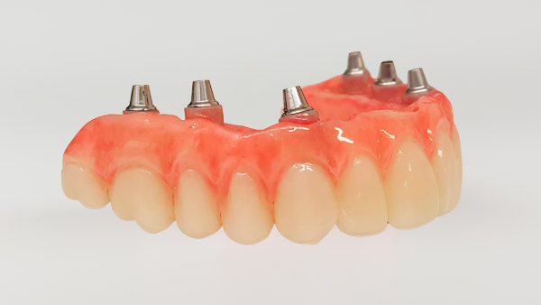 Implant Supported Dentures