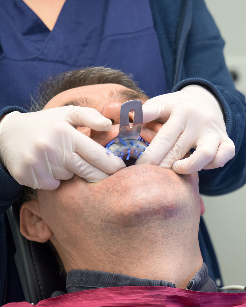 Having an impression taken for custom mouthguard