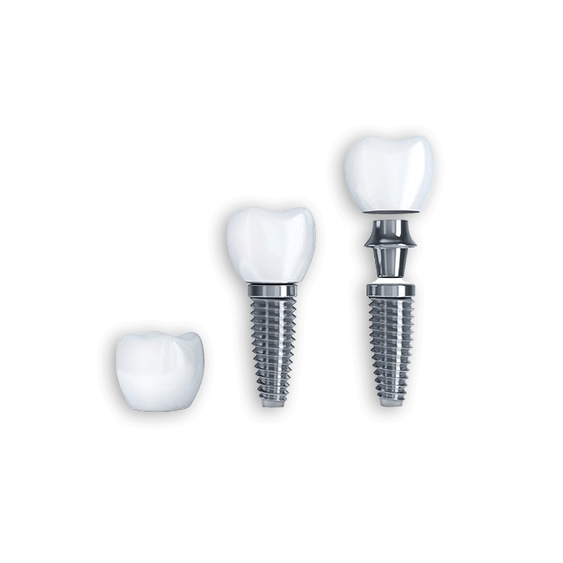Dental Implants Treatment